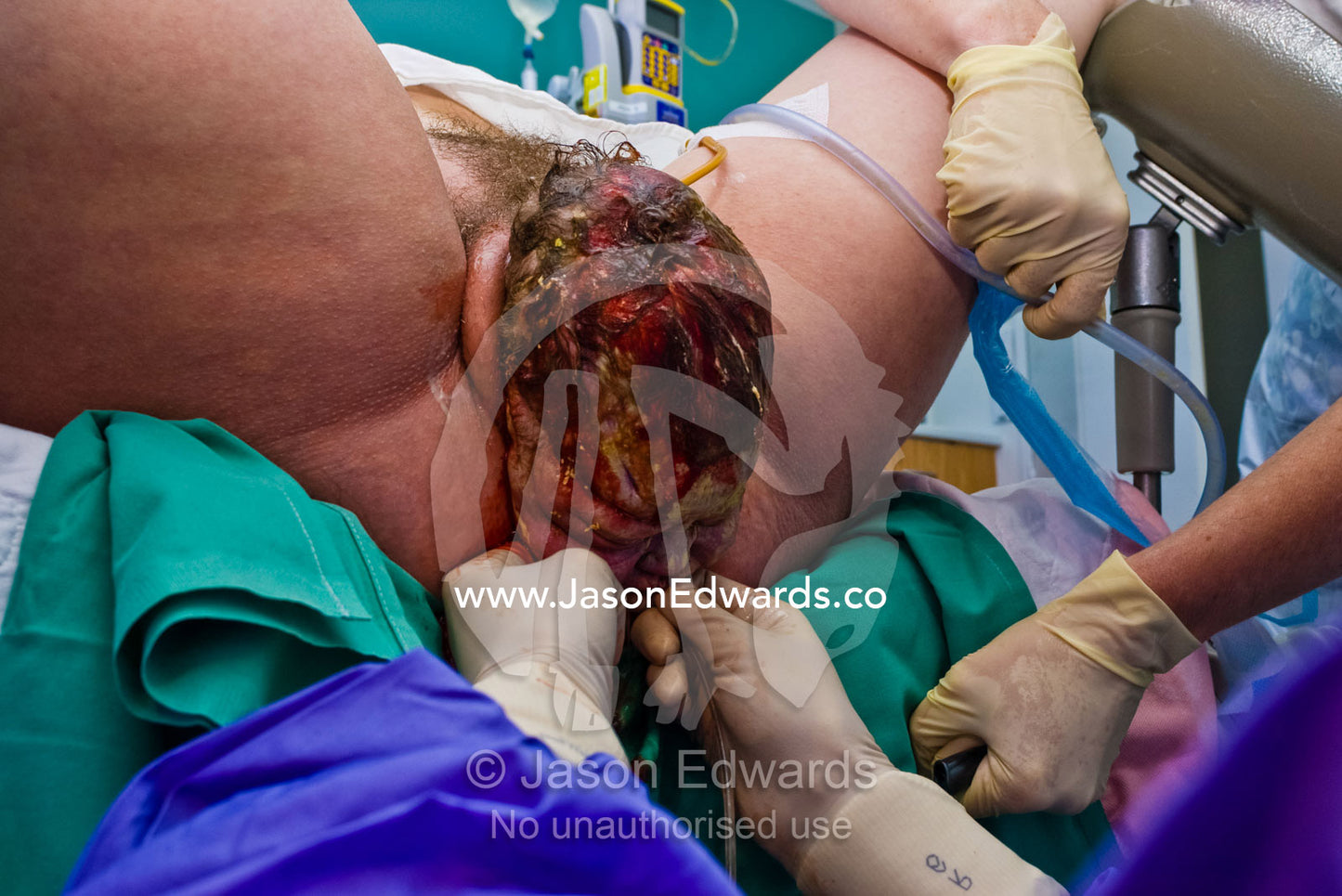 An obstetrician clears a babies airway during the birth process. Frances Perry House, Carlton, Victoria, Australia.