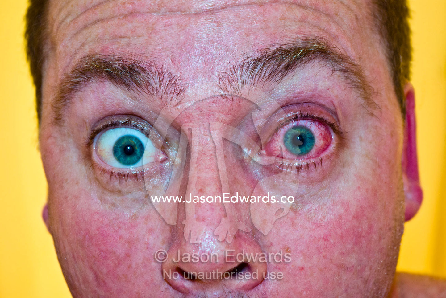 Green pupils and a blood red eyeball with a conjunctivitis infection. North Carlton, Melbourne, Victoria, Australia.
