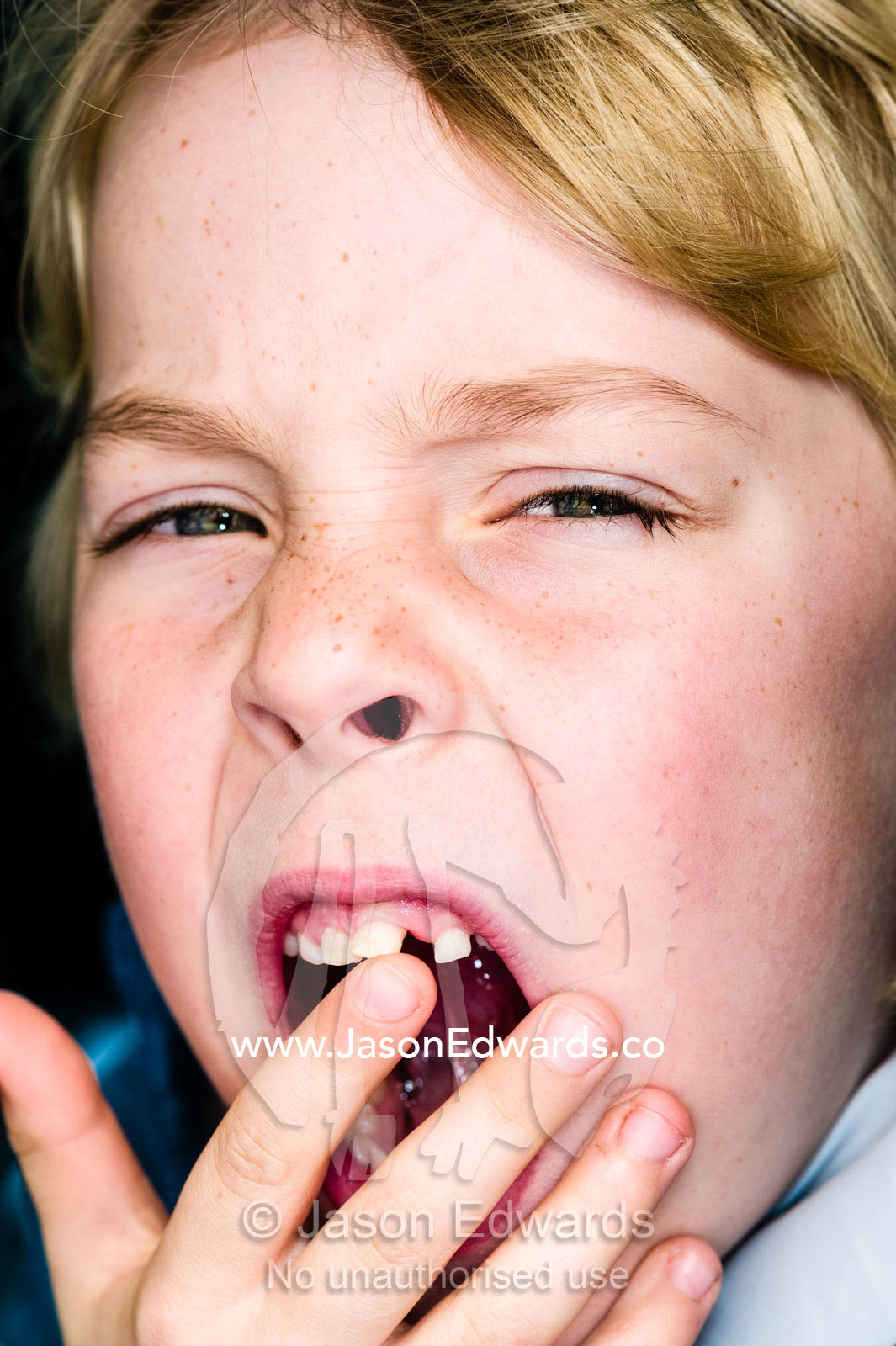 A boy displays a wobbly incisor tooth that is loose enough to fall out. Collingwood, Melbourne, Victoria, Australia.