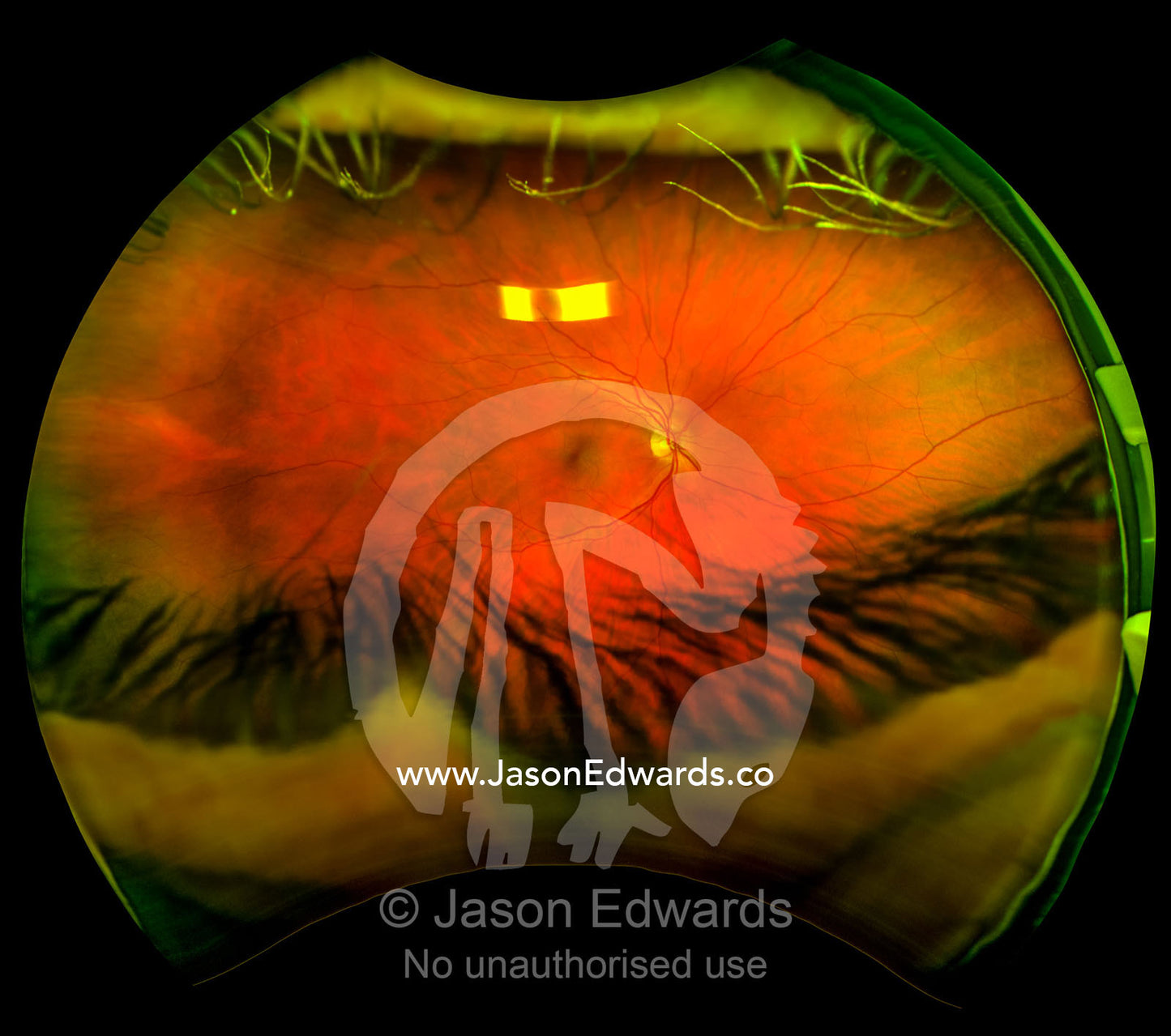 An ultra wide digital retinal scan of a human eye showing the veins and capillaries in a retina. Brunswick, Melbourne, Victoria, Australia.