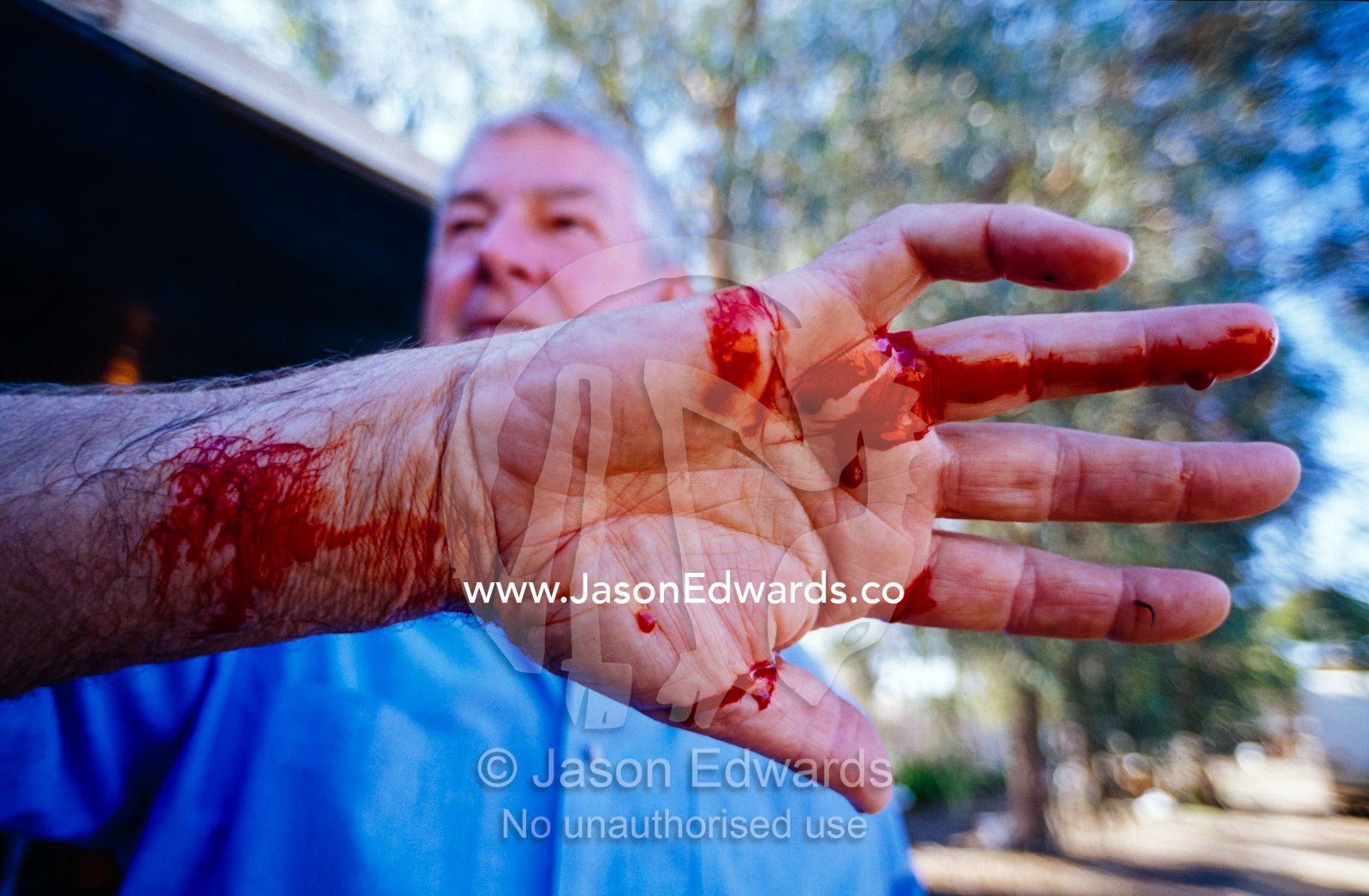 Blood pours from the hand of a leech farmer after removing leeches. Echuca, Victoria, Australia.