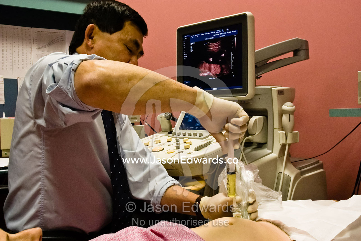 A doctor draws amniotic fluid into a syringe from a pregnant woman. East Melbourne, Victoria, Australia.