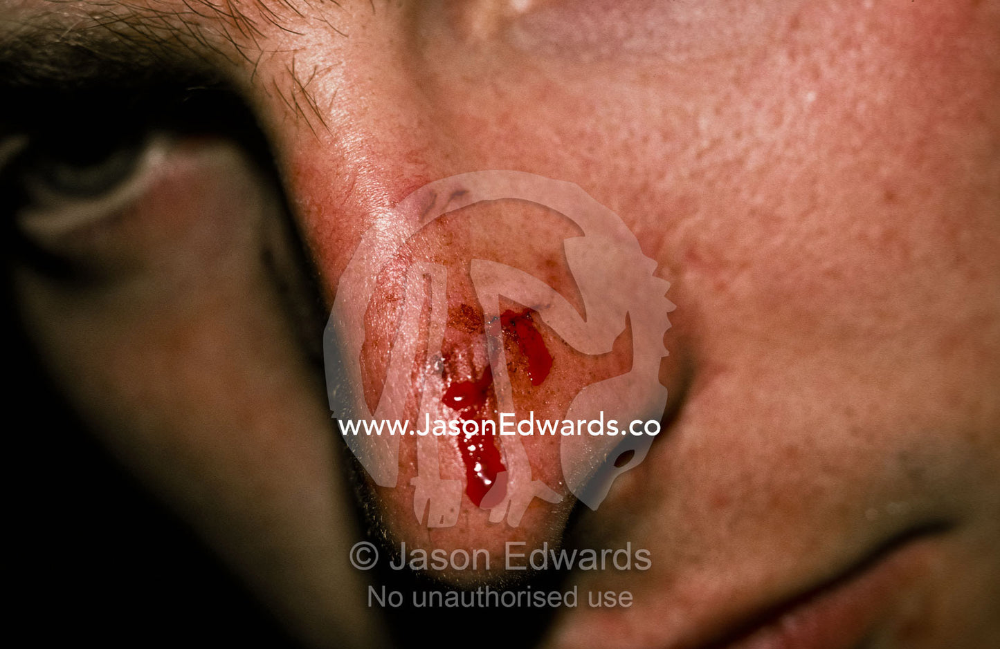 A man bleeds from a severe bite on nose by an aggressive Water Python North Carlton, Victoria, Australia.