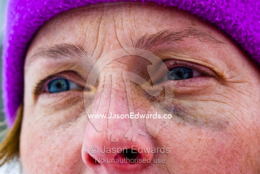 Bruises start to appear beneath a woman's eye after an impact. Mount Hotham, Victoria, Australia