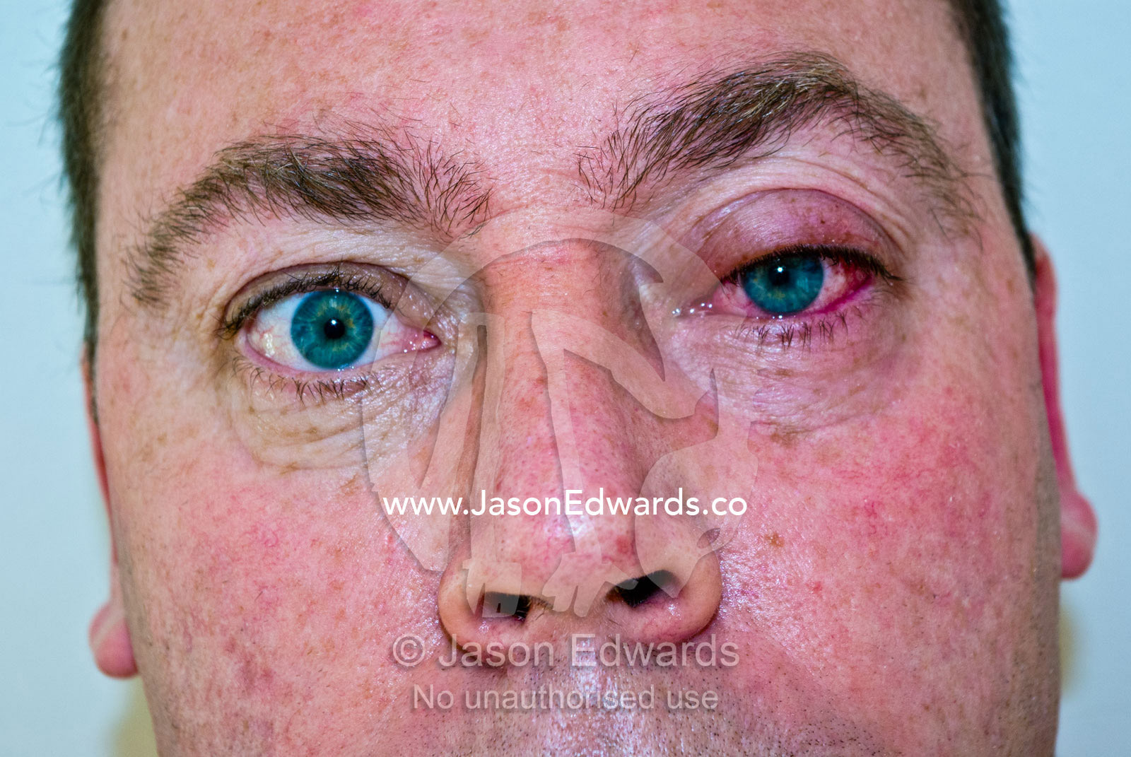 Green pupils and a blood red eyeball with a conjunctivitis infection. North Carlton, Melbourne, Victoria, Australia.