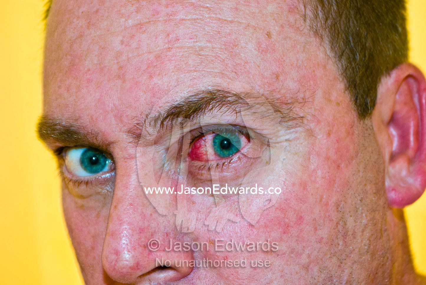Green pupils and a blood red eyeball with a conjunctivitis infection. North Carlton, Melbourne, Victoria, Australia.