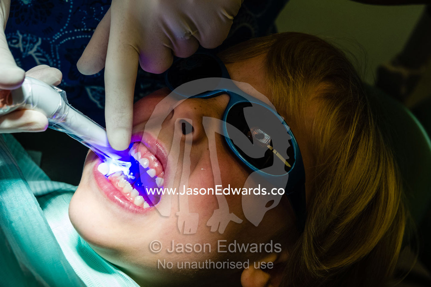 A dentist uses an ultra violet light to set composite fillings in the molars of a young boy. East Melbourne, Melbourne, Victoria, Australia.