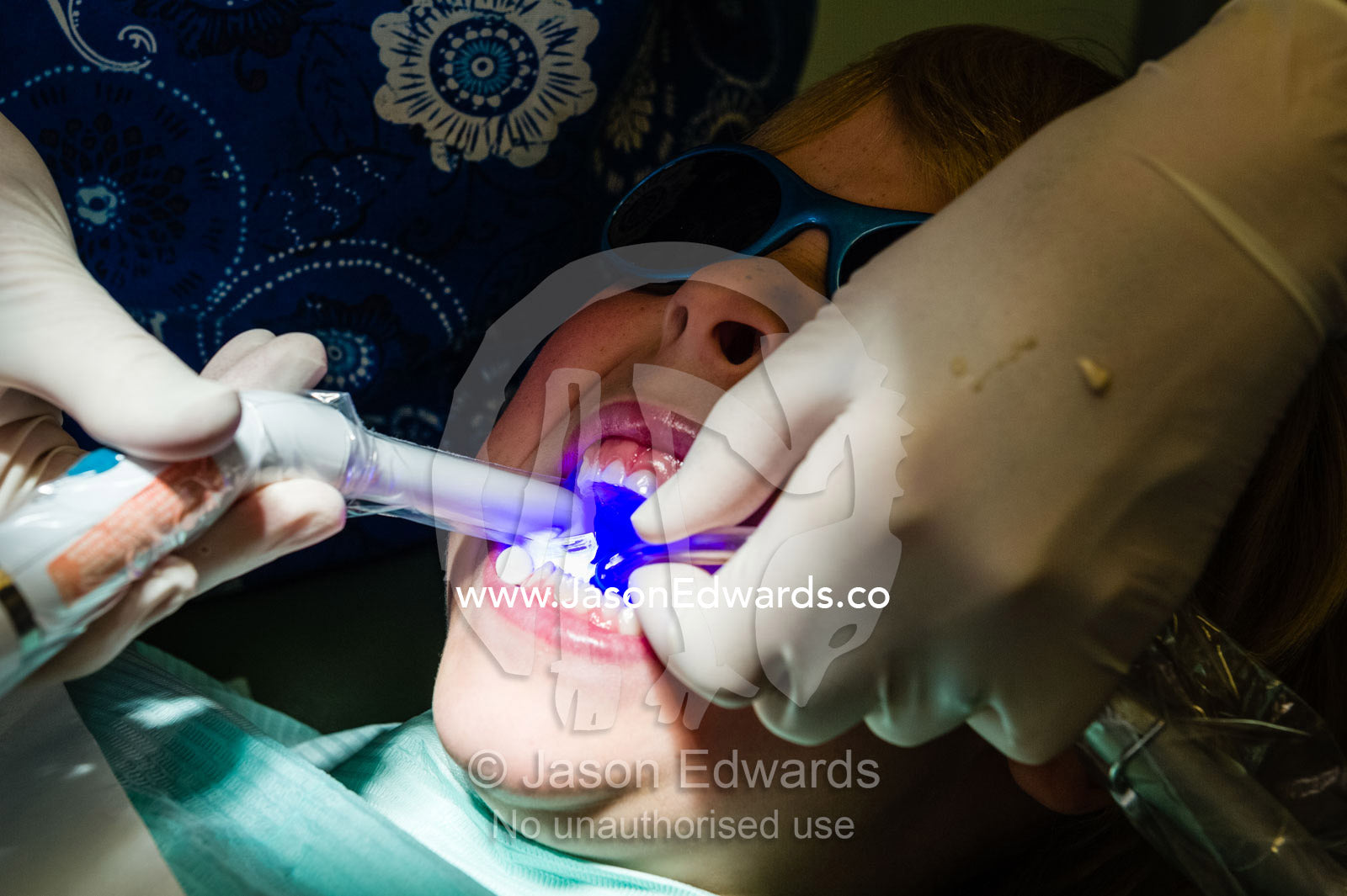 A dentist uses an ultra violet light to set composite fillings in the molars of a young boy. East Melbourne, Melbourne, Victoria, Australia.