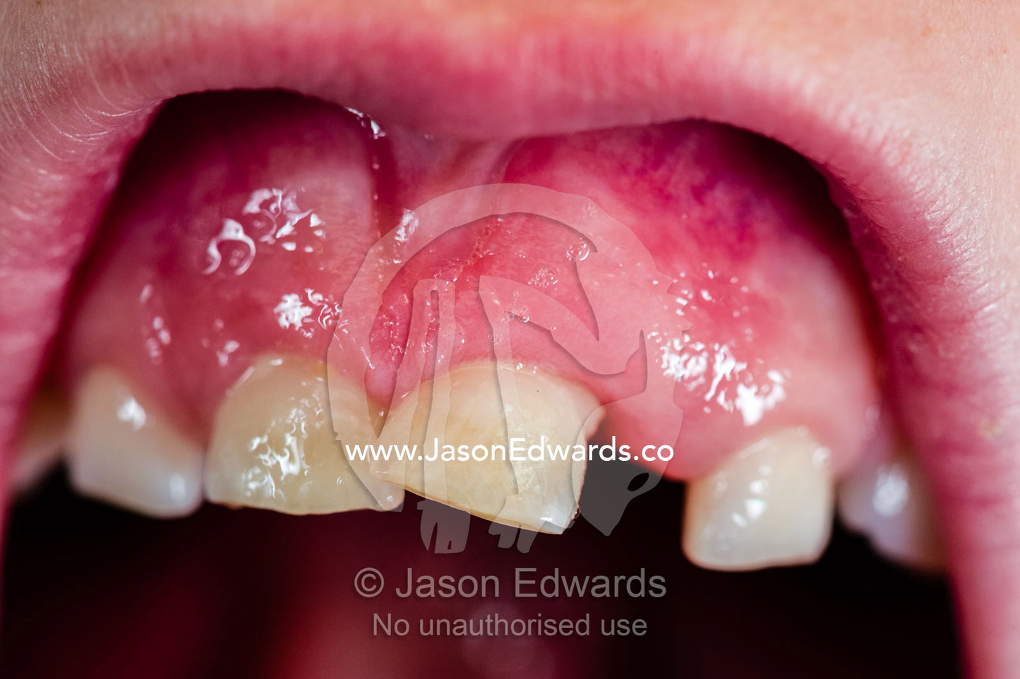 A boy displays a wobbly incisor tooth that is loose enough to fall out. Collingwood, Melbourne, Victoria, Australia.
