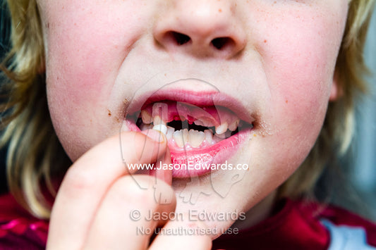 A boy displays his tooth that has fallen out and the gap in his teeth. Collingwood, Melbourne, Victoria, Australia.