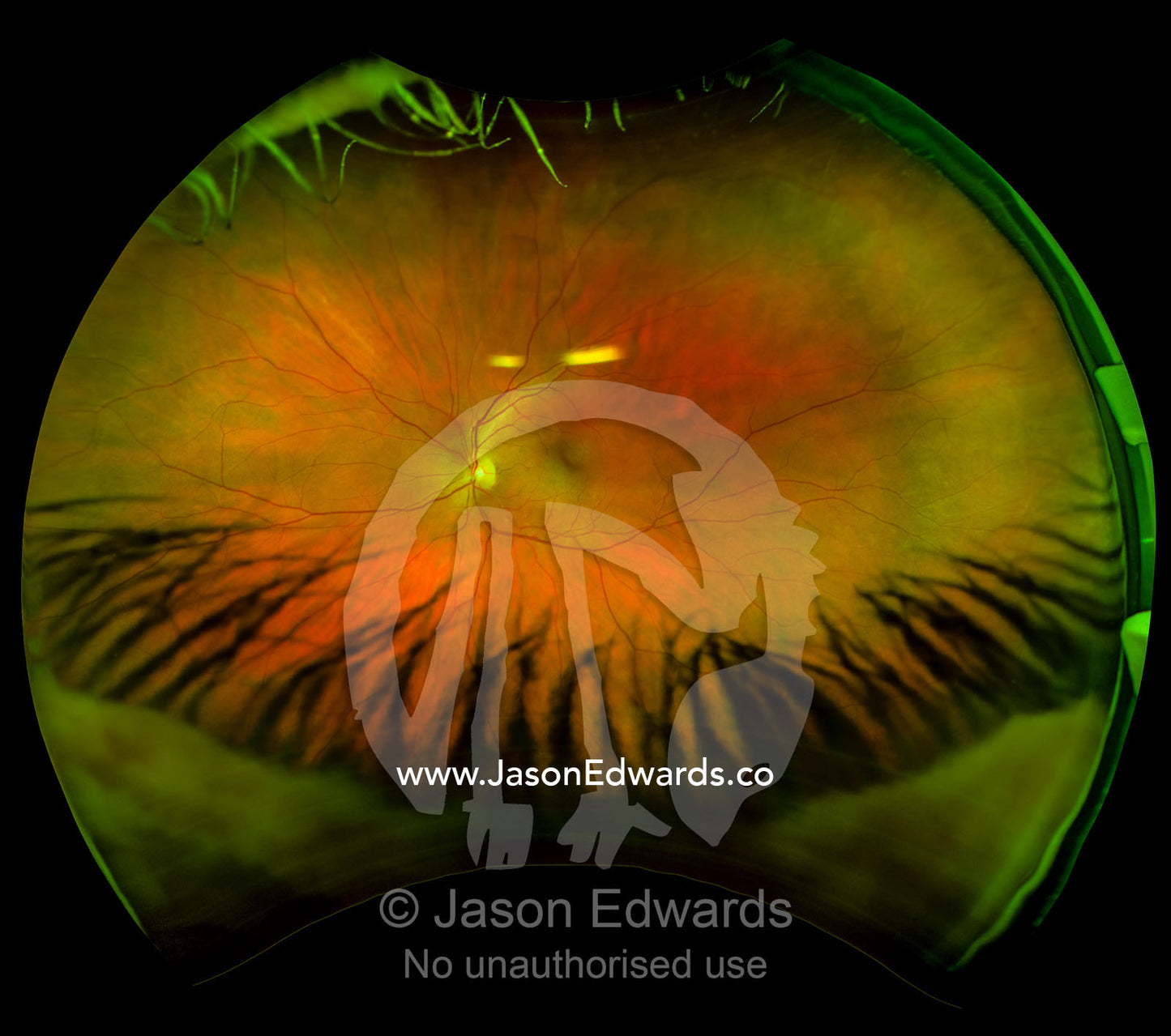 An ultra wide digital retinal scan of a human eye showing the veins and capillaries in a retina. Brunswick, Melbourne, Victoria, Australia.