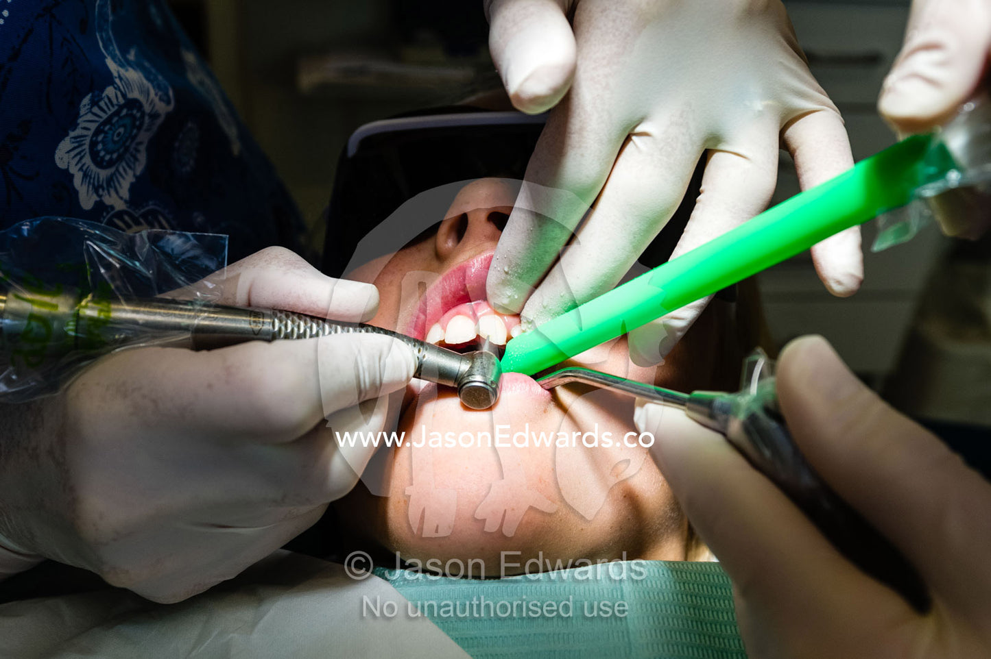 A dentist drills and files a broken tooth before repairing it with a cap. Melbourne, Victoria, Australia.